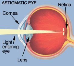 astigmatic